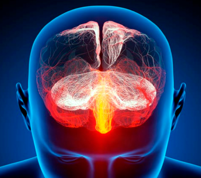 Cada año 120 mil argentinos sufren un ACV