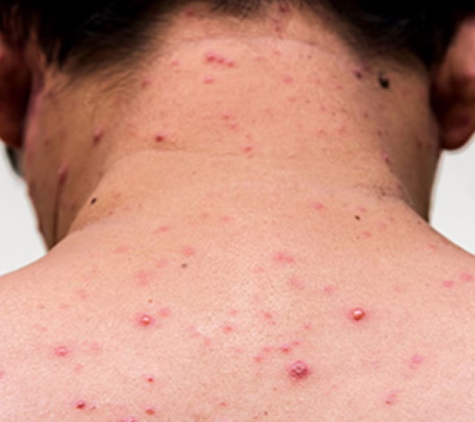 Alerta Sanitaria en el AMBA: Ya son 13  los casos confirmados de Sarampión