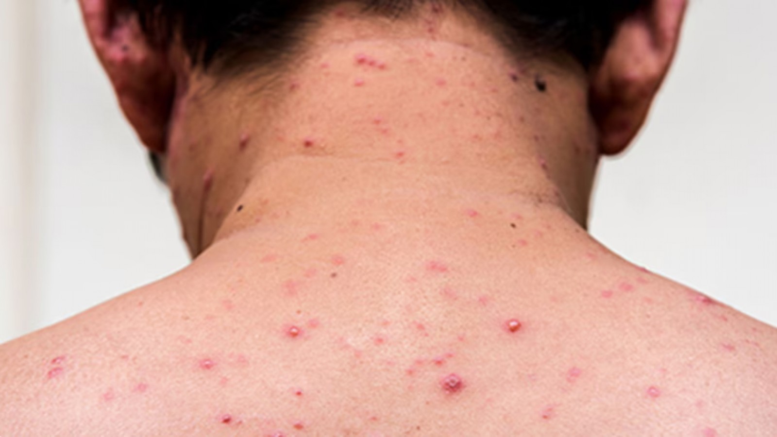 Alerta Sanitaria en el AMBA: Ya son 13  los casos confirmados de Sarampión