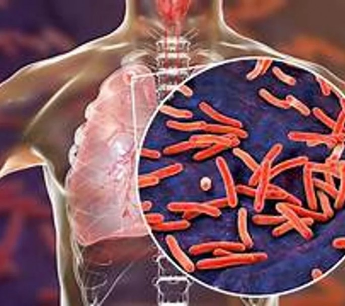 Alarmante aumento del 38% en casos de tuberculosis en Argentina
